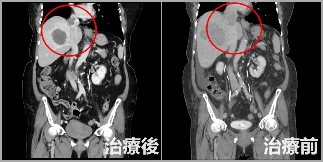 79歲婦腿腫狂喘竟是肝癌末期！醫揭「三合一療法」成功續命 提醒這症狀要警惕