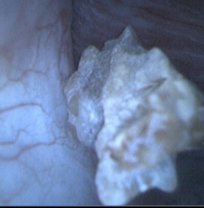 頑強結石「震不碎」!闆娘腎臟深處痛不欲生 醫新式輸尿管鏡一夾出