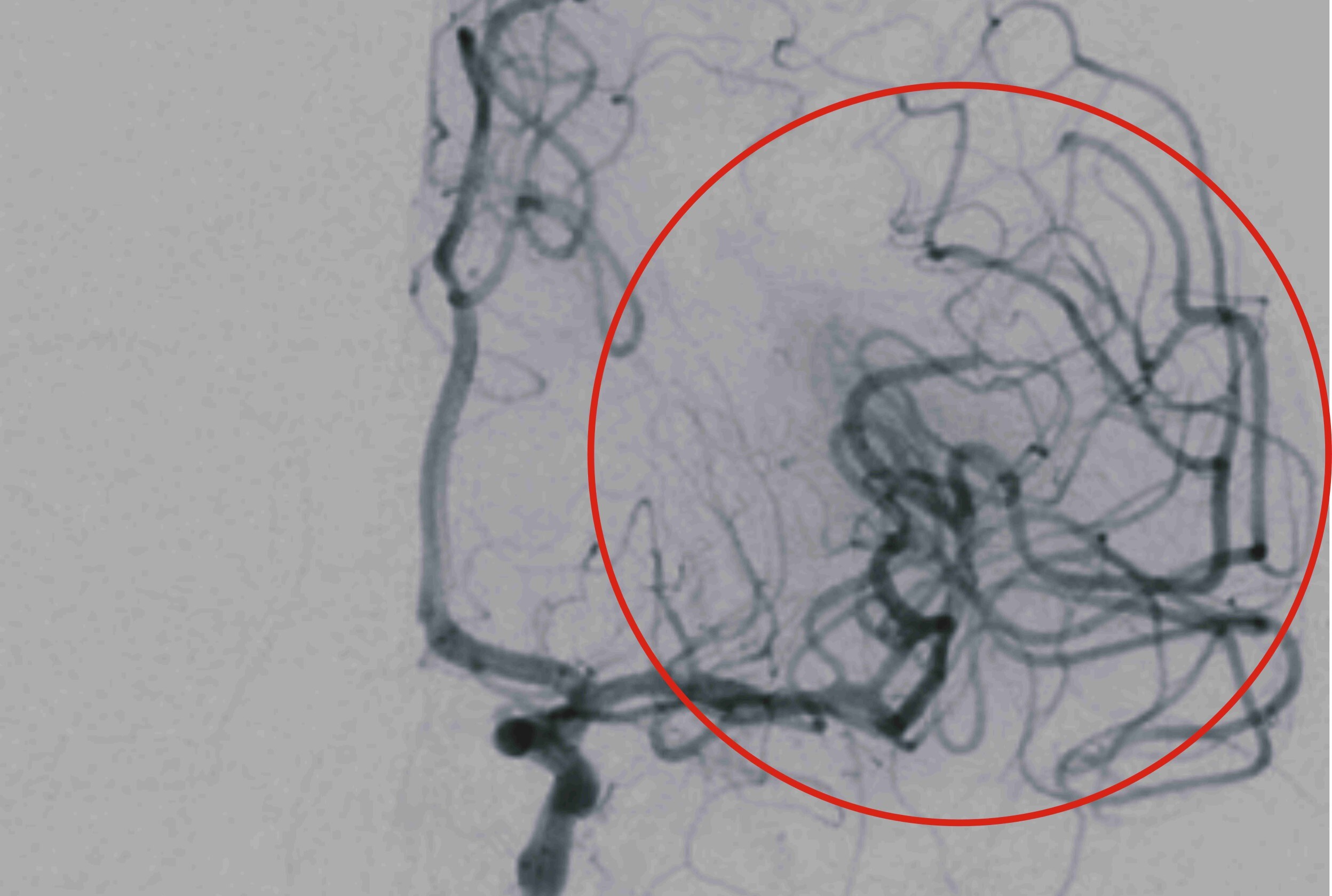 中風年輕化!彰基熟女訪友突倒地 醫「1習慣」揭罹病原因