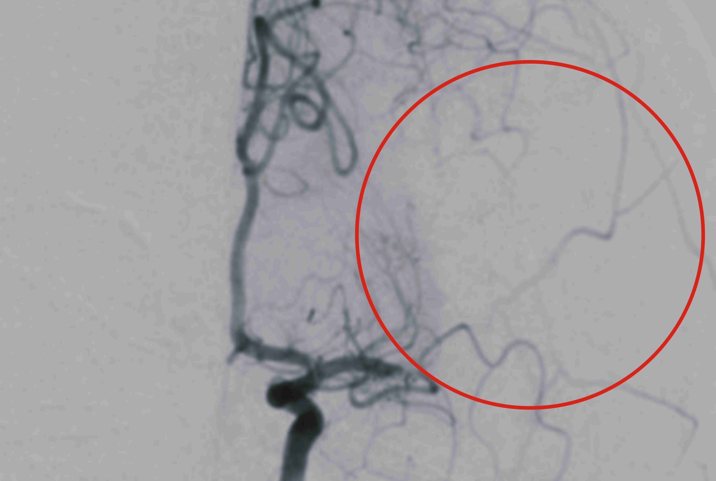 中風年輕化!彰基熟女訪友突倒地 醫「1習慣」揭罹病原因