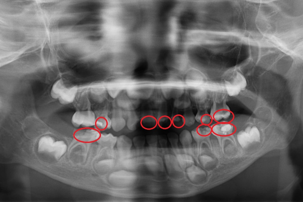  乳牙蛀牙引發蜂窩性組織炎：兒童牙醫教你五大護齒秘訣