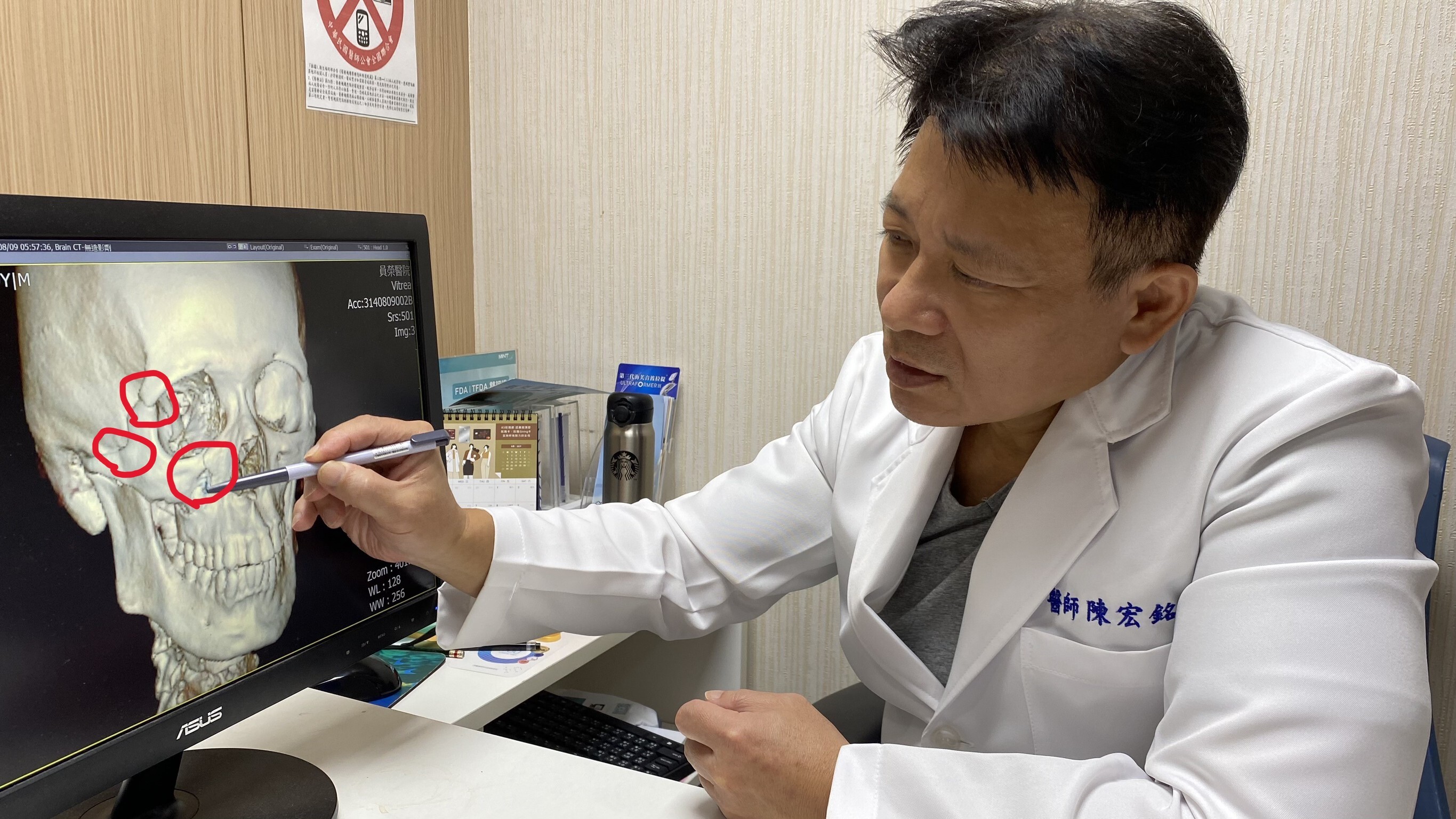 兩歲童意外撞斷母親鼻骨,專家提醒顏面骨折黃金治療期