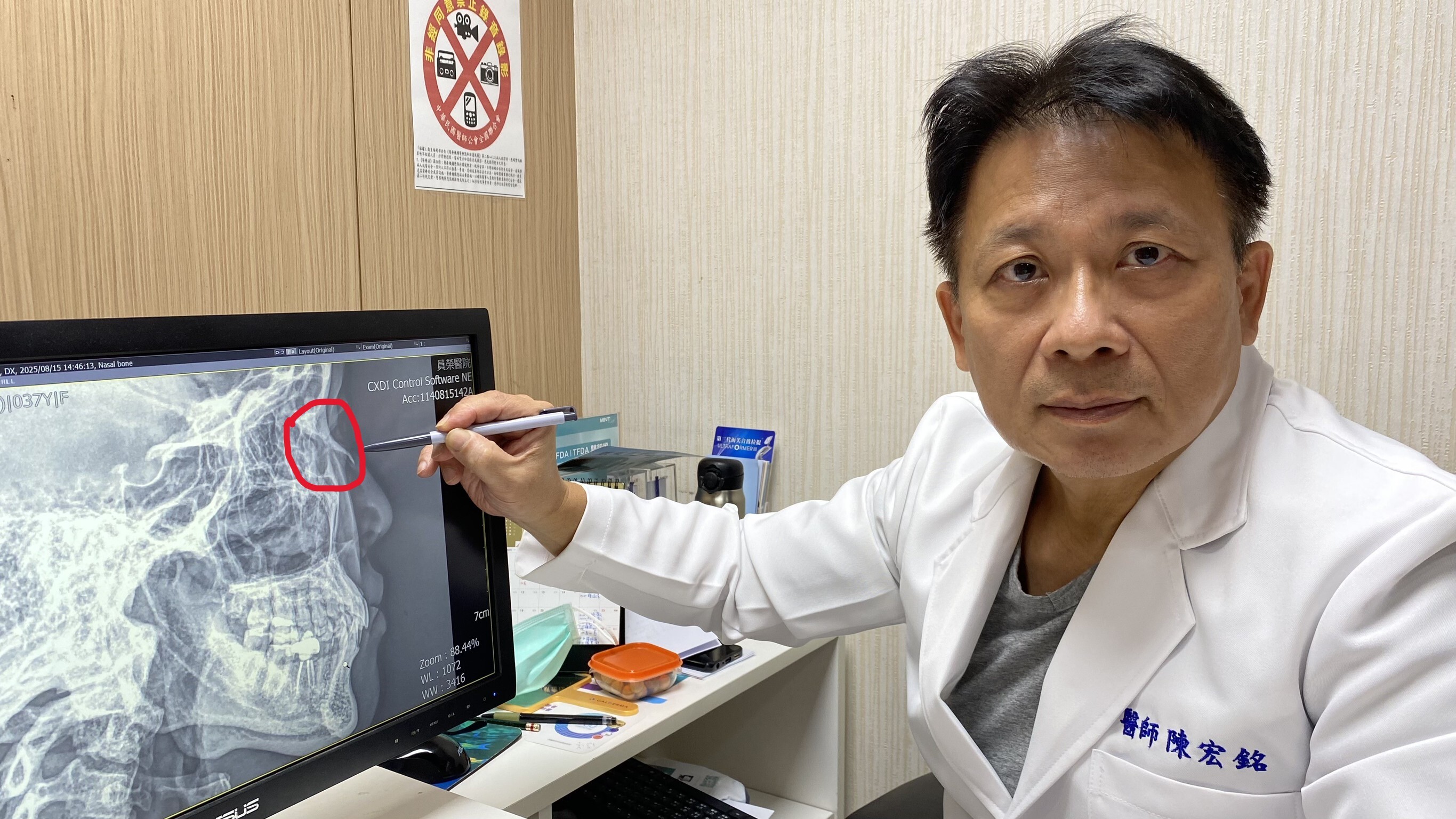 二歲兒往媽媽鼻子一撞「鼻骨斷了」　醫：顏面骨折恐影響咀嚼、視力