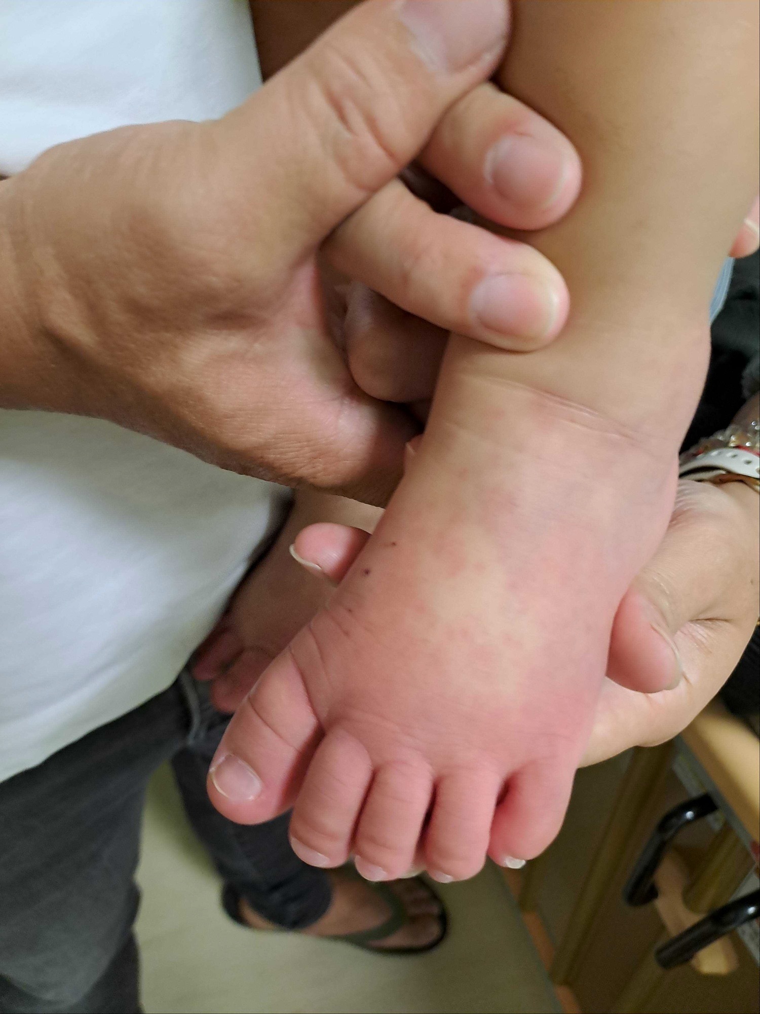  2歲男童高燒不退 川崎病險釀危機