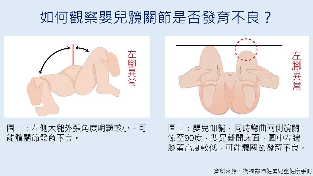  孩子換尿布「咔嗒」聲響？小心髖關節發育不良