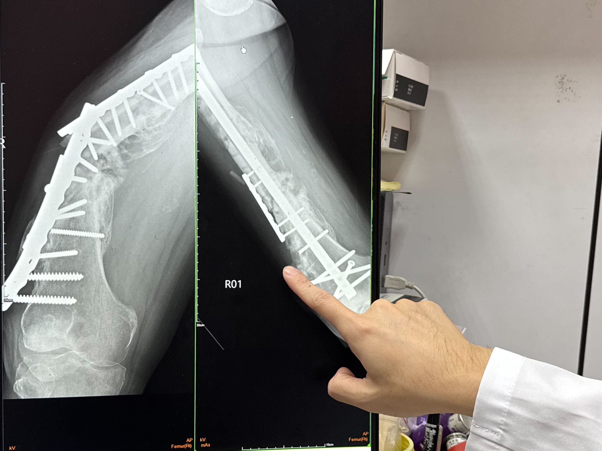 **82歲老翁重獲新生：骨折後再站起來，期待再隨大甲媽祖遶境**