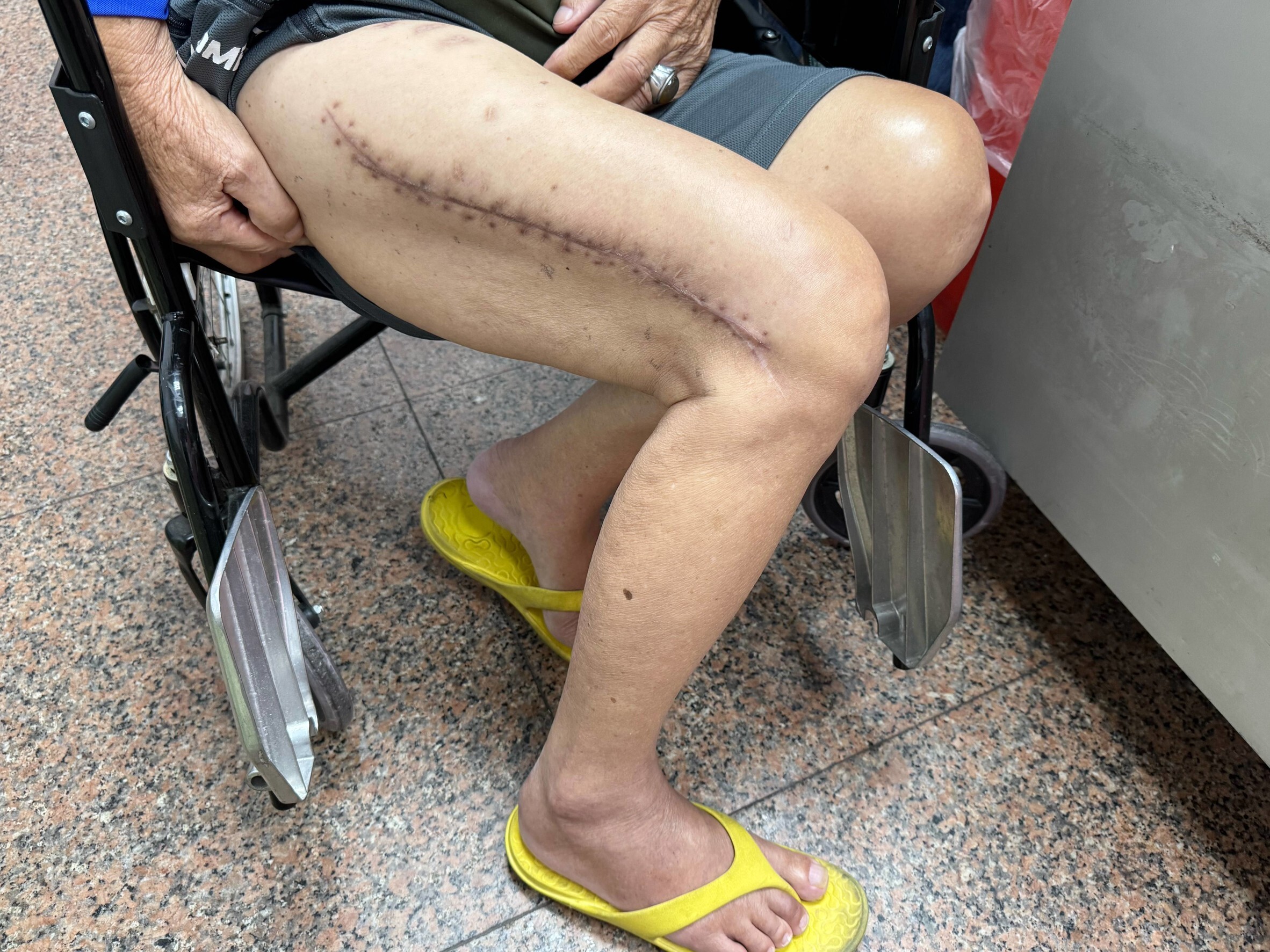 82歲老翁車禍「鋼板斷3截」！經3次手術　感動喊：明年要回去走媽祖