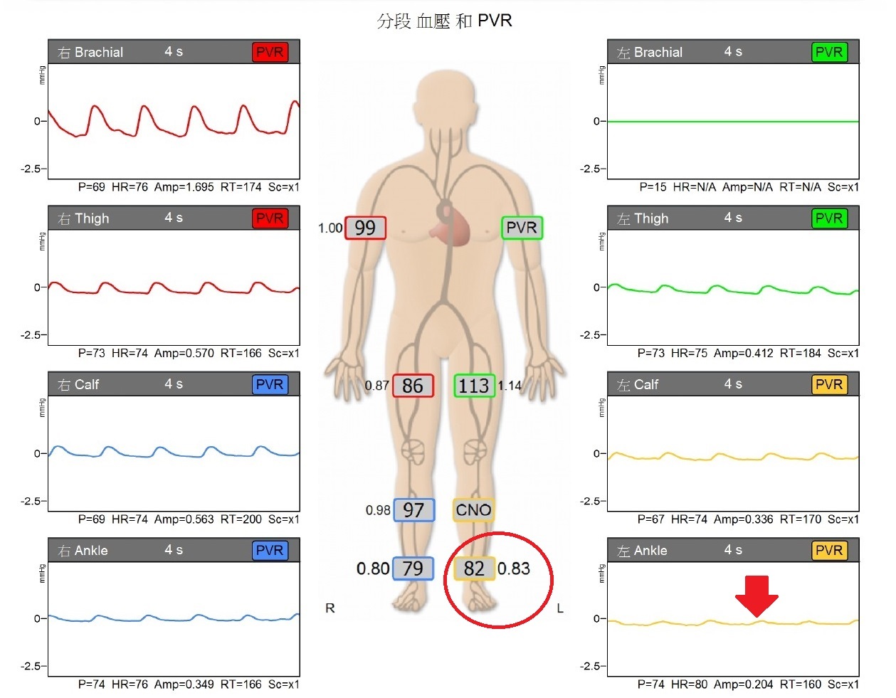 【健康警訊】冬季腳痛不只是天冷!75歲老翁痛訴走路痛,竟是周邊動脈阻塞!