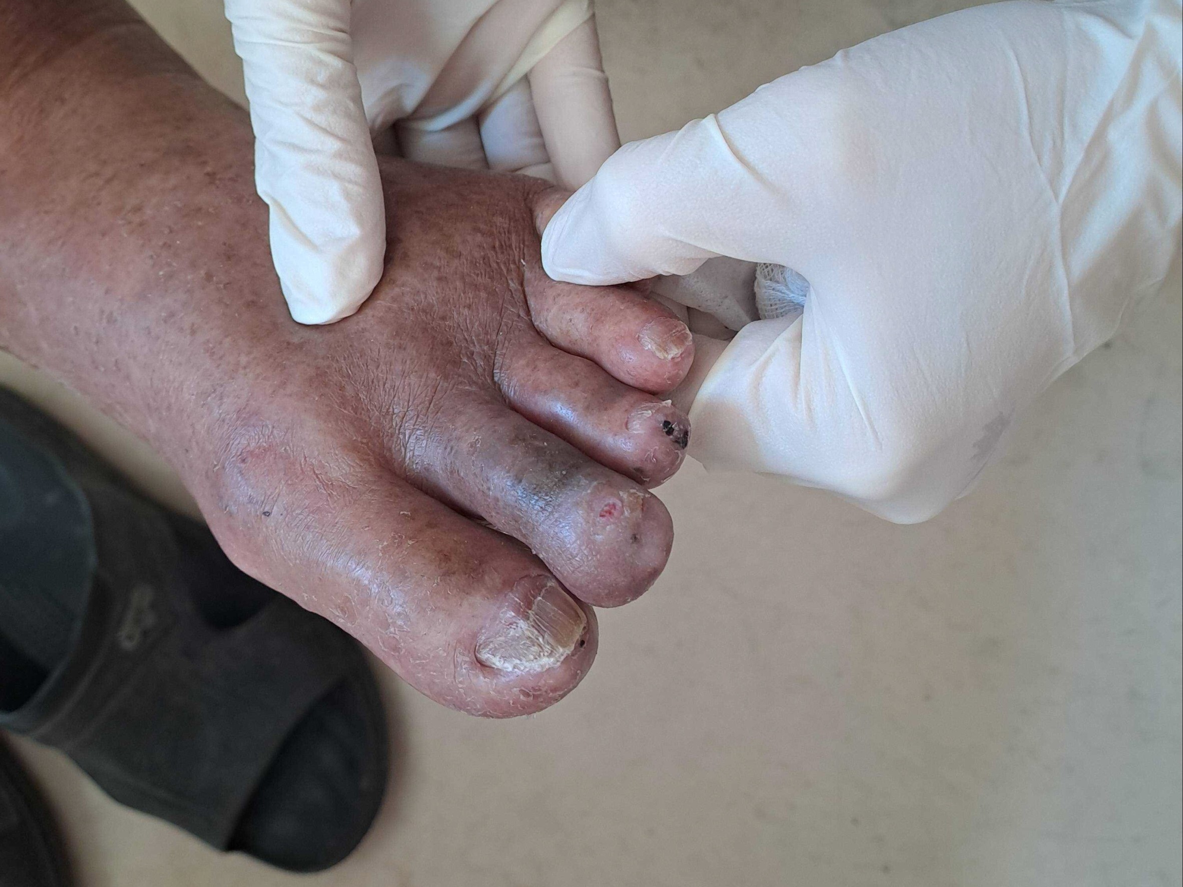 【健康警訊】冬季腳痛不只是天冷!75歲老翁痛訴走路痛,竟是周邊動脈阻塞!