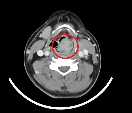【健康警訊】沙啞不止?可能是癌症警訊!63歲男子因忽視症狀,罹患下咽癌四期